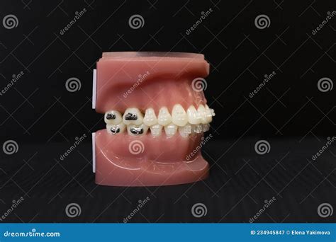 Orthodontic Jaw Model Demonstration Teeth With Ceramic Bracket Or
