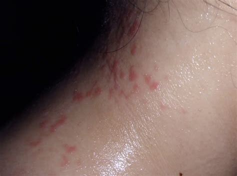 Itchy Neck Pictures Symptoms Treatment Rash Causes