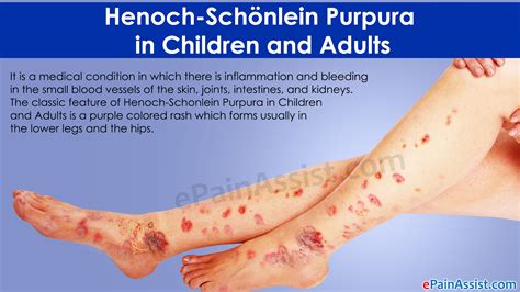 Henoch Schönlein Purpura In Children And Adults