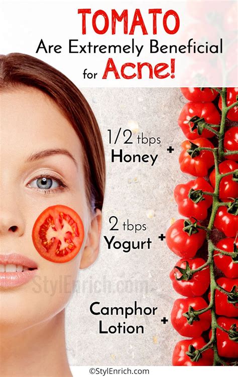 Tomato For Acne Do You Know Tomato Are Extremely Beneficial For Acne