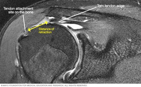 How To Read Mri Images For A Torn Rotator Cuff Prdelta