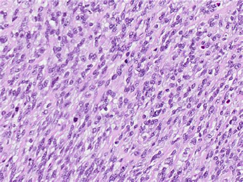 A Phyllodes Tumour Classified As Borderline Reveals Stromal