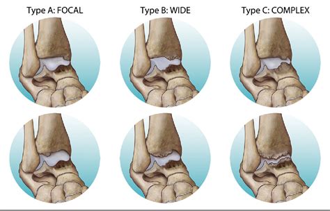Pdf Arthroscopic Treatment Of Ankle Anterior Bony Impingement