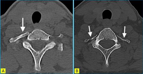 Axial Ct Images Of The Cervical Spine In Two Different Patients Show