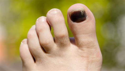 Black Toenail Caused By Diabetes Diabeteswalls