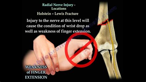 Radial Nerve Injury Locations Everything You Need To Know Dr