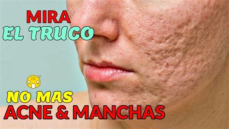 Como curar y como ganar. Como Curar El Acné 😮 Eliminar El Acné Y Sus Manchas ...