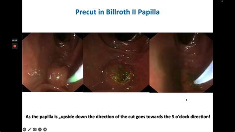 Ercp And Sphincterotomy In Billroth Ii Anatomy Youtube