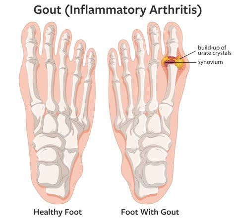 Foot Gout Treatment In Frisco Tx Rnv Podiatry