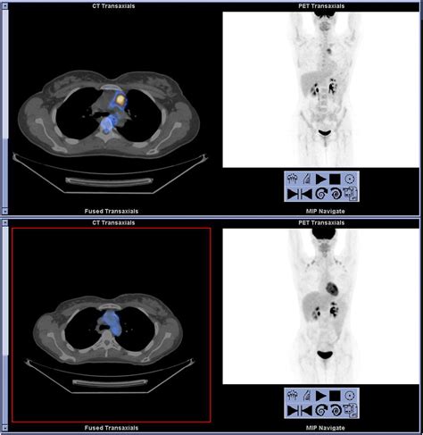 18f Fdg Pet And Petct In The Evaluation Of Cancer Treatment Response