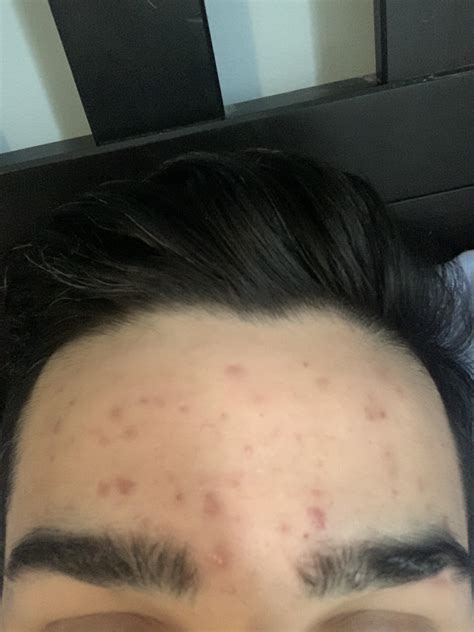 Skin Concerns My Forehead Has So Many Red Bumps Its Been Like This