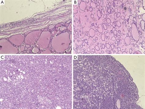 Histopathology Report Colloid Goiter With Cystic Degeneration Of