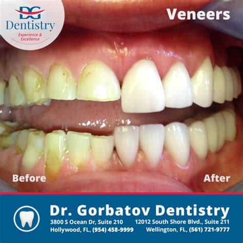 How Much Does A Smile Makeover Cost Gorbatov Dentistry Your