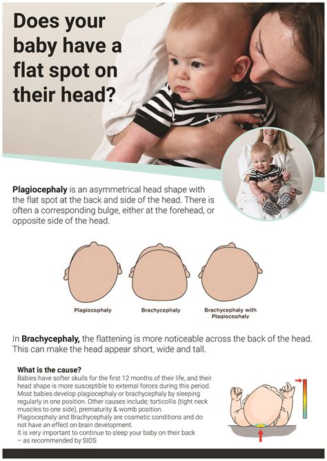 Assessment And Evaluation For Babys Flat Head Plagiocephaly