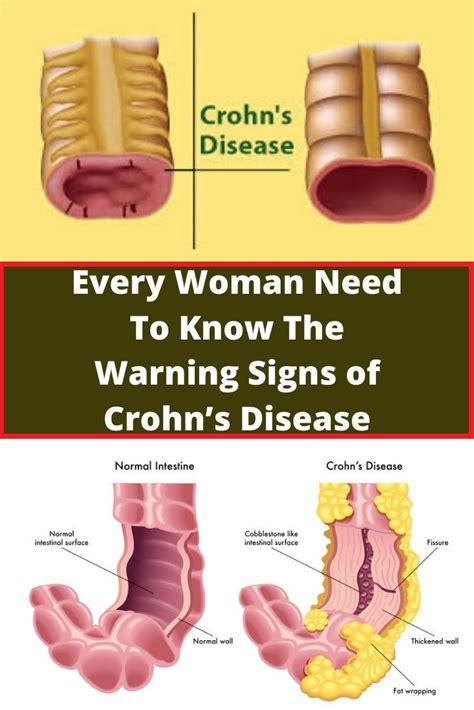 Every Woman Need To Know The Warning Signs Of Crohns Disease Crohns Disease Healthy Skin