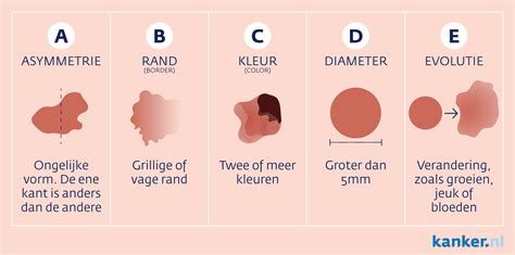 Het Herkennen Van Huidkanker Skn2 Cosmetische Dermatologie Utrecht