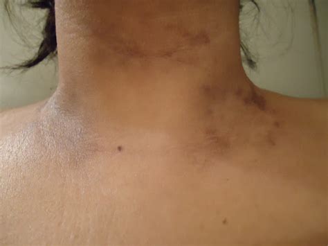 What Causes Little Black Freckles On The Neck And How To Treat