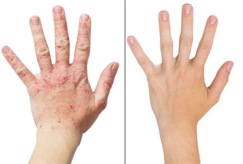 Pompholyx Dyshidrotic Eczema Eczema Free