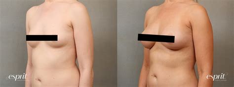 Breast Augmentation With Fat Transfer Esprit Cosmetic
