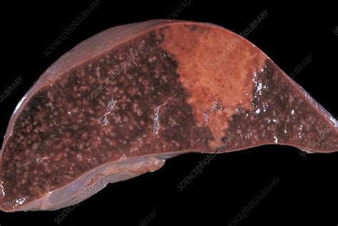 Anaemic Infarct Of The Spleen Stock Image C0499116 Science Photo