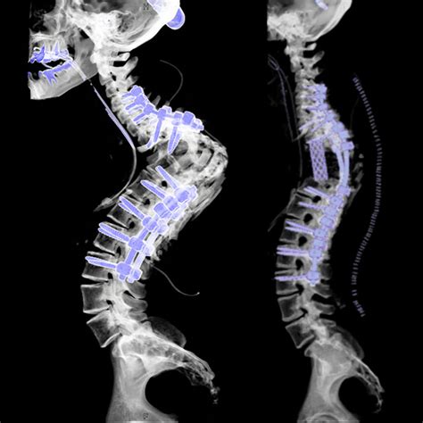 Major Spinal Reconstruction 6 Vertebral Segments Removed To Restore
