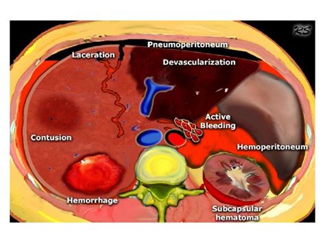 Abdominal Trauma An Overview