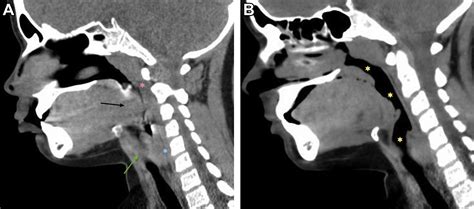 Laryngeal Edema In A Child With Hereditary Angioedema With Normal C1