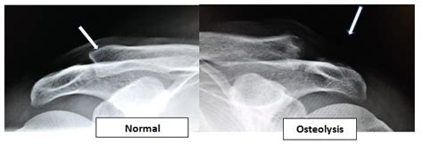 Weight Lifters Shoulder Distal Clavicle Osteolysis