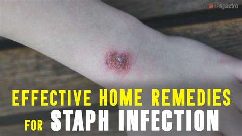 9 Effective Home Remedies For Staph Infection Youtube