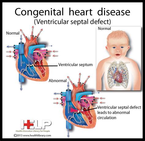 Pin By Lindsey Morrison On Chd Congenital Heart Pediatric Nursing