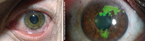 Herpes Keratitis Learn More At Texas Eye Surgeons