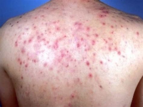 Why Does Hidradenitis Suppurativa Hurt Home Remedies For Pimples