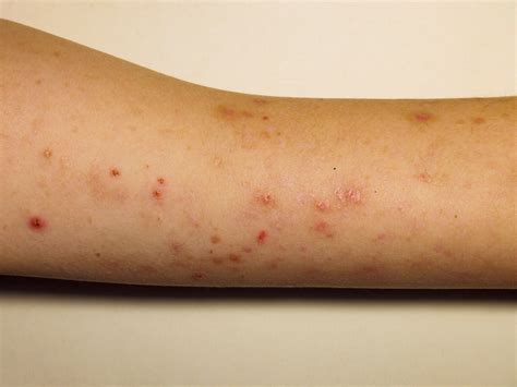 Pictures Of Skin Rashes