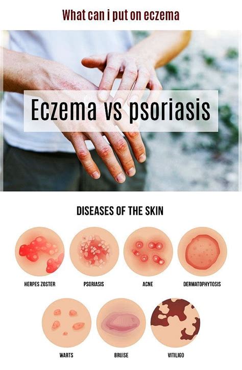 Eczema Vs Psoriasis Eczema Is A Relatively Rare Skin Condition That