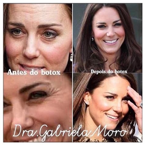 Arriba 92 Foto Botox En La Cara Antes Y Después Mirada Tensa