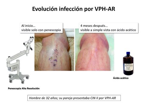 El Vph Virus Del Papiloma Humano La Its M S N En Hombres