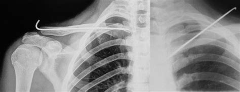 Xray Shows A K Wire Fixation On Middle Third Clavicle Fracture And The