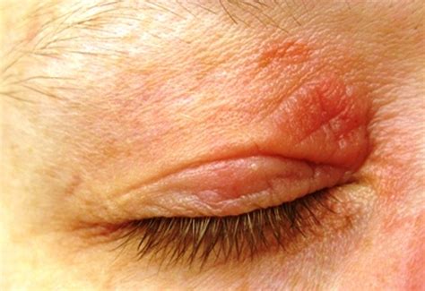 Psoriasis Eyelid Pictures Photos