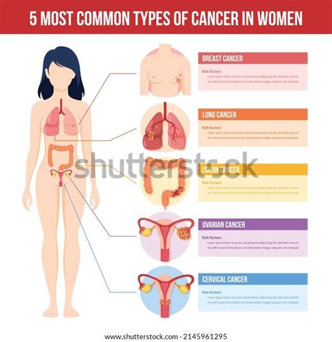 Infographic Most Common Types Cancer Stock Vector Royalty Free Shutterstock