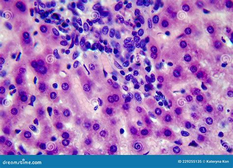 Coccidiosis Coccidia In Liver Light Micrograph Stock Image Image Of Pathology Pink 229255135