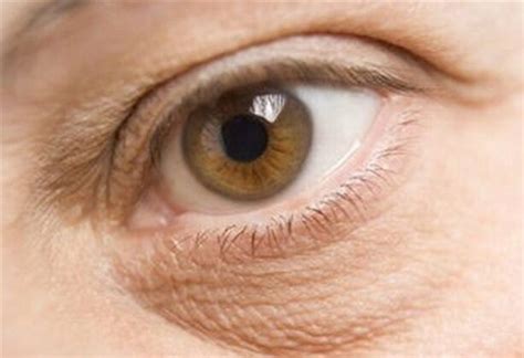 Dry Skin Around The Eyes Causes Symptoms And Natural Treatments