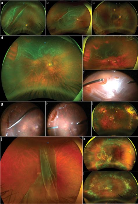 Types Of Giant Retinal Tears Download Scientific Diagram
