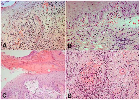 Histological Features Of Eschars Intra And Subepidermal Download