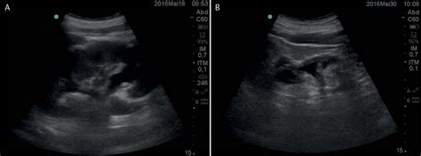 Scielo Brasil Point Of Care Kidney Ultrasonography And Its Role In