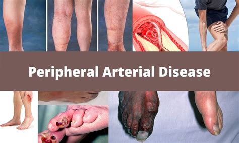 Most Common Cause Of Peripheral Arterial Disease Kulturaupice