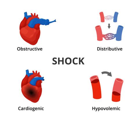 Cardiogenic Shock Stock Photos Pictures And Royalty Free Images Istock