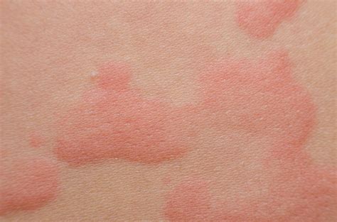 What skin conditions often cause itching? Skin Problems That Could Be a Sign of Serious Disease ...