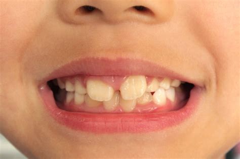 歯 列 矯正 顎 の 歪み