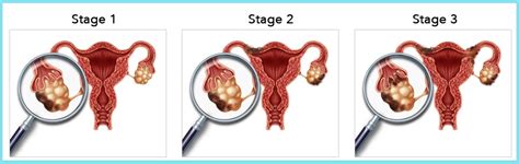 Ovarian Cancer Types And Stages