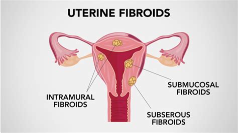 Fibroids Endometriosis Pcos And Dyspareunia A Primer On These Common Reproductive Problems